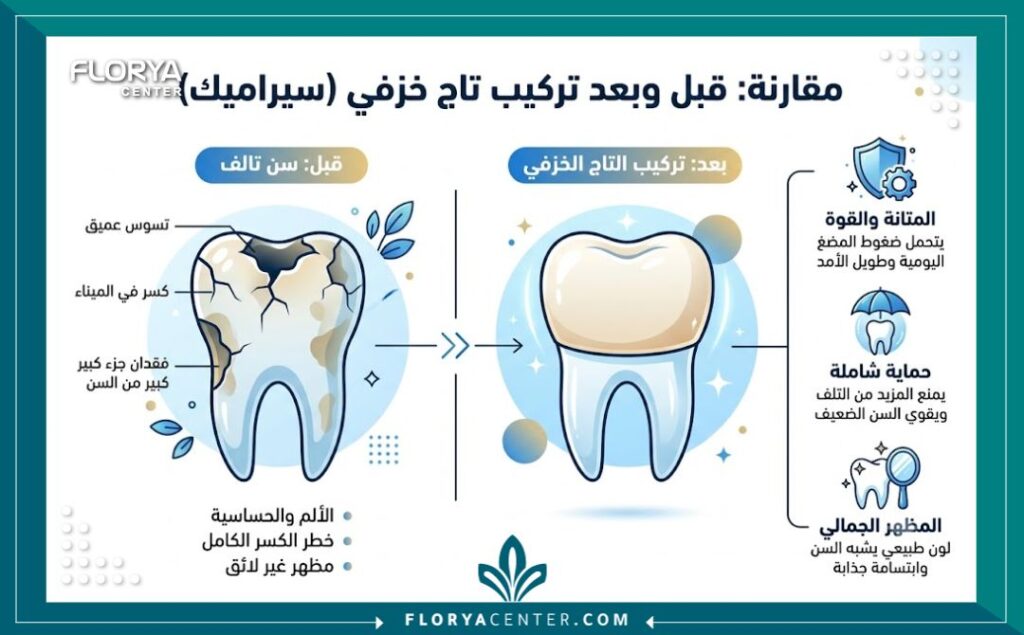 تلبيسة سيراميك في تركيا 3 إنفوجرافيك يوضح الفوائد والفرق قبل وبعد تركيب تلبيسة سيراميك للأسنان.