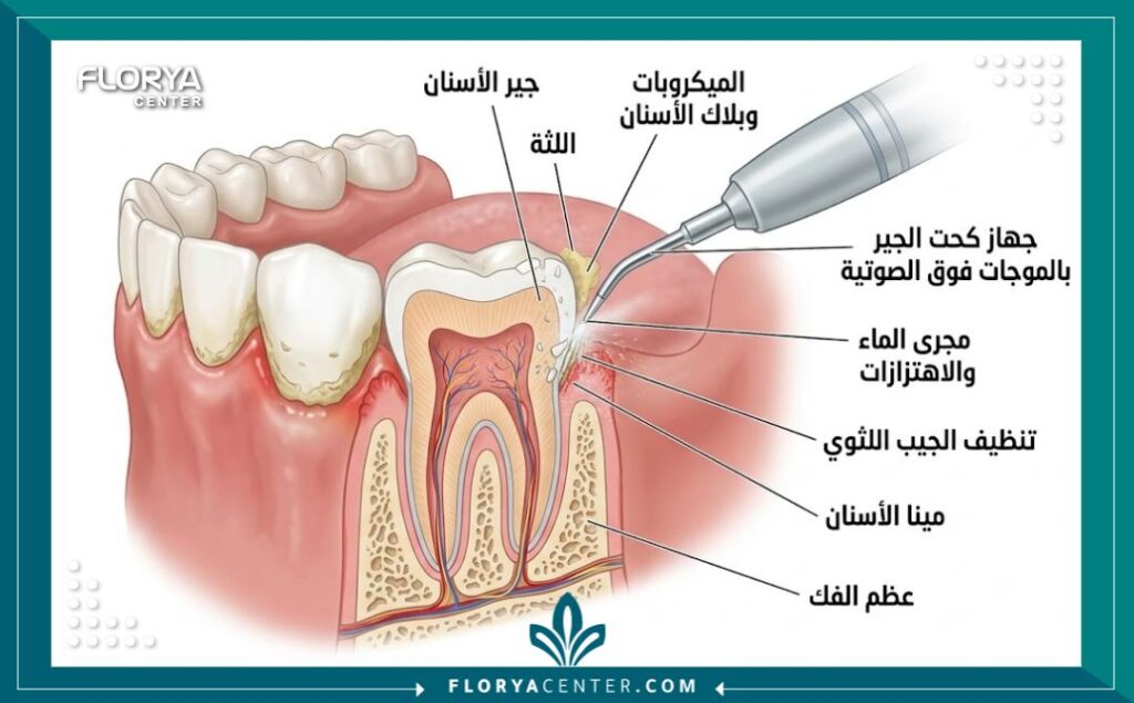 تنظيف الاسنان في تركيا 2 رسم توضيحي طبي يوضح عملية إزالة الجير المتراكم وتنظيف الجيوب اللثوية باستخدام جهاز الموجات فوق الصوتية.