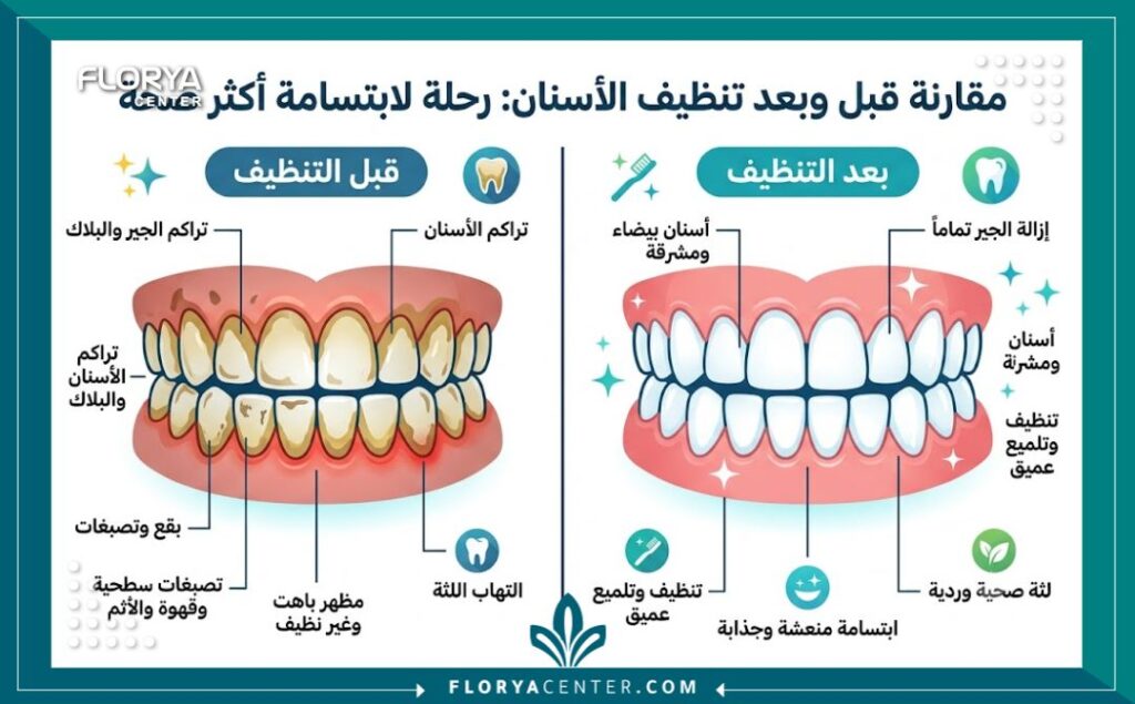 تنظيف الاسنان في تركيا 3 إنفوجرافيك يقارن بين حالة الأسنان قبل وبعد تنظيف التصبغات السطحية وإزالة طبقة البلاك في عيادات الأسنان.
