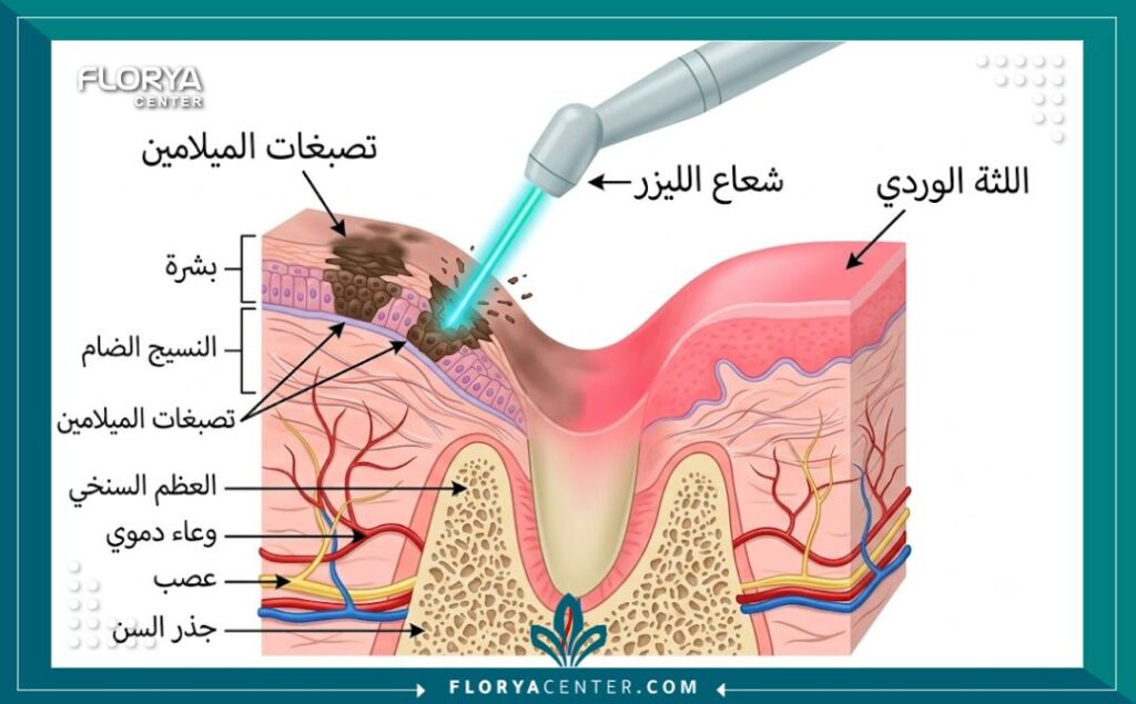 مخطط طبي يوضح آلية عمل الليزر في إزالة تصبغات اللثة الداكنة وتوريدها.