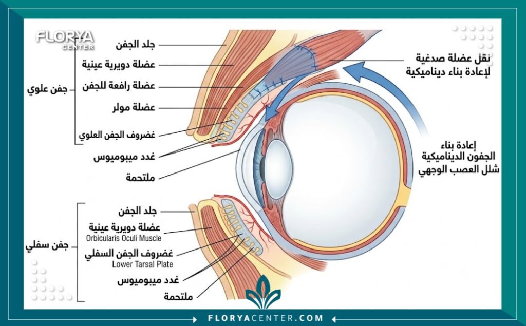 رسم توضيحي طبي لتشريح الجفون وتقنيات جراحة الجفون الترميمية لاستعادة الوظيفة في تركيا