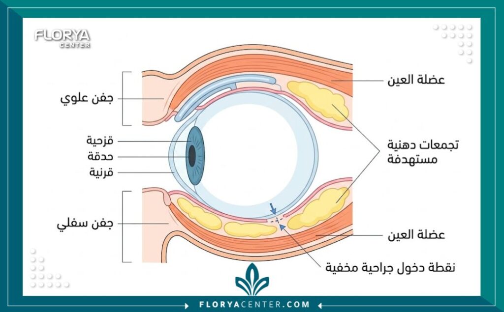 جراحة الجفون طفيفة التوغل 2 رسم تخطيطي طبي يوضح تشريح الجفن ونقاط التدخل الجراحي الدقيق لعملية شد الجفون طفيفة التوغل بدون شقوق خارجية.