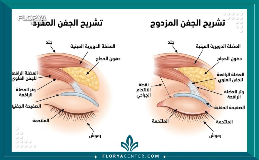 جراحة تجميل الجفن المزدوج 2 مخطط تشريحي طبي يوضح الفرق بين بنية الجفن المفرد والجفن المزدوج، مع تسميات دقيقة باللغة العربية تظهر تعديل العضلات والجلد.