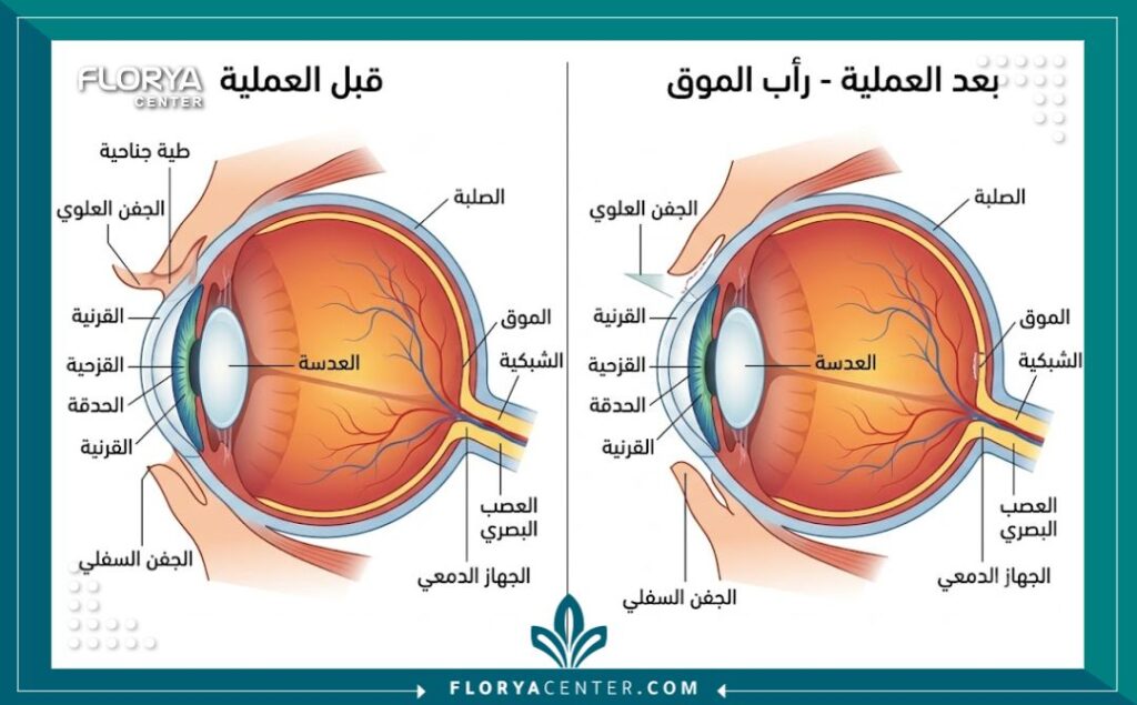 رسم توضيحي طبي يشرح تشريح الطية الجلدية (الطية المنغولية) قبل وبعد جراحة الإيبكانثوبلاستي.