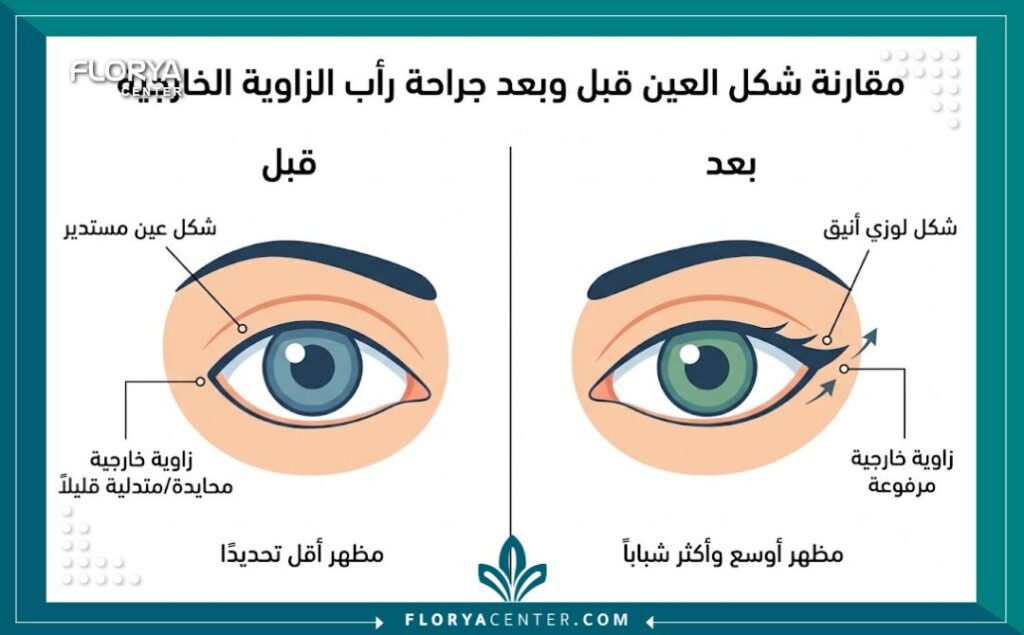 إنفوجرافيك يوضح الفرق بين شكل العين قبل وبعد عملية رفع طرف العين الخارجية للحصول على عيون لوزية مسحوبة.