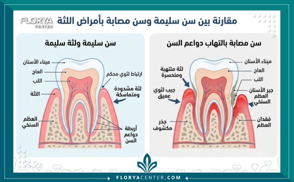 إنفوجرافيك طبي يقارن بين اللثة السليمة واللثة المصابة بجيوب اللثة ويوضح الفراغات المرضية.