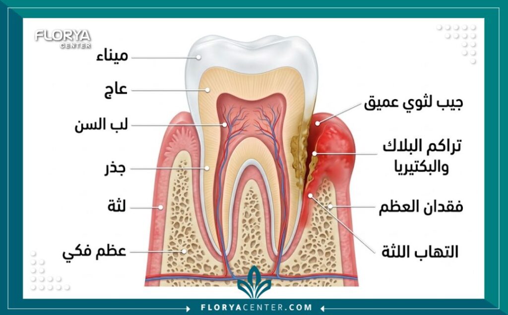 صورة مقربة لابتسامة صحية ولثة وردية سليمة تعبر عن نجاح علاج جيوب اللثة في تركيا.