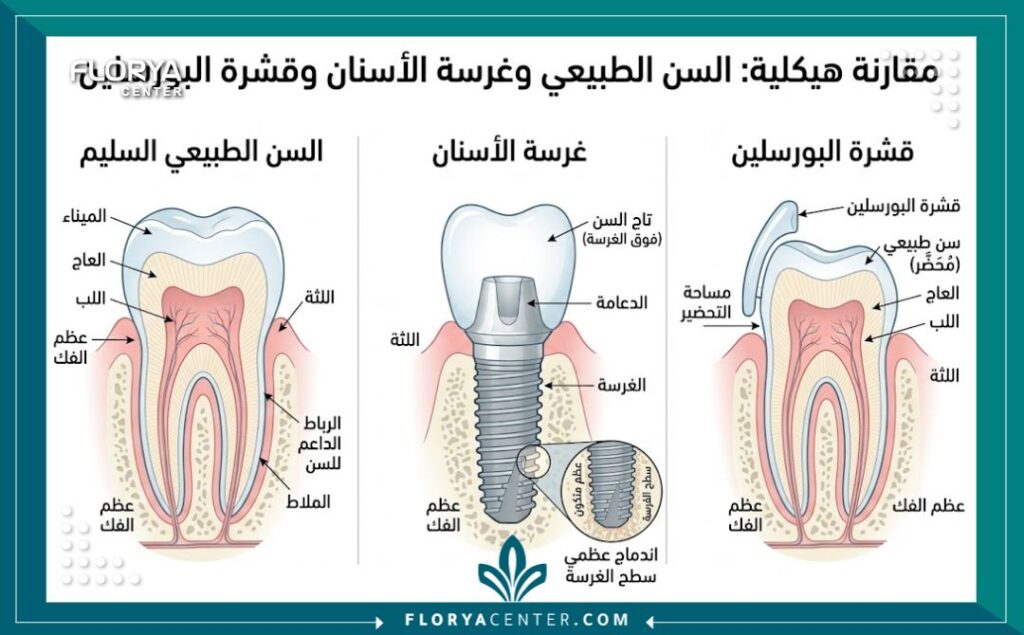رسم توضيحي طبي يبين تركيب زراعة الأسنان وقشور الفينير، دليلك الشامل قبل حجز موعد طبيب اسنان في تركيا.
