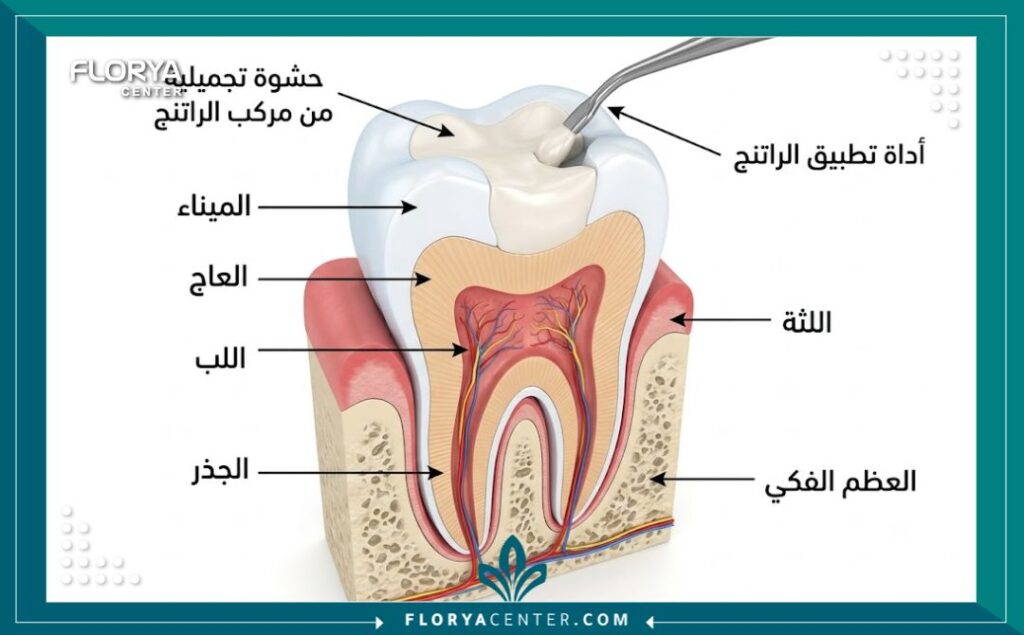 رسم توضيحي طبي يبين تشريح السن وكيفية اندماج حشوات الكومبوزيت البيضاء لتطابق لون السن الطبيعي.