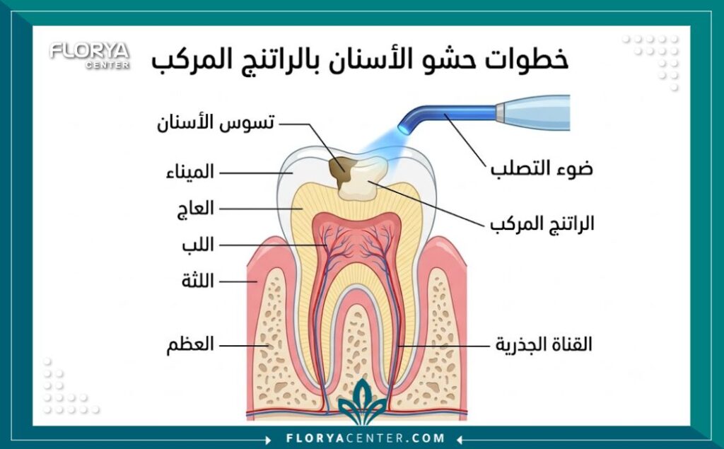 رسم توضيحي لطبقات السن يوضح كيفية تطبيق الحشوات الضوئية التجميلية.