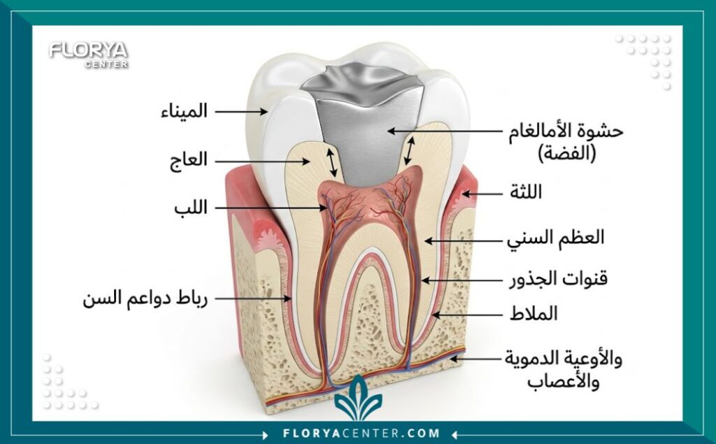 رسم توضيحي طبي يوضح تكوين حشوة البلاتين الفضية أو الأملغم داخل طبقات السن.