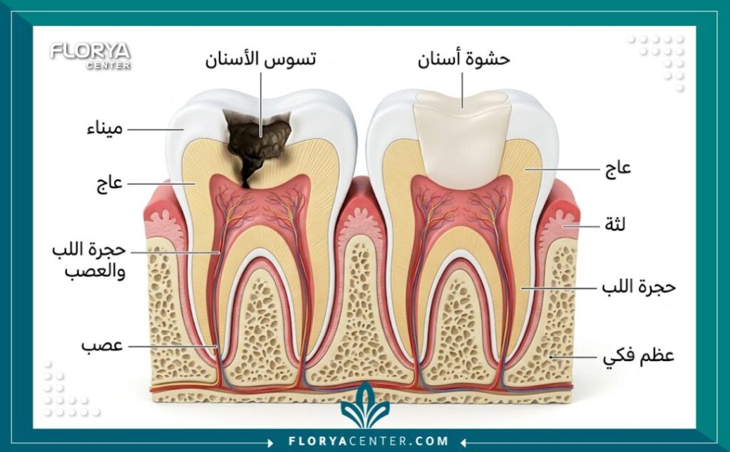 رسم توضيحي طبي لطبقات السن يوضح كيفية عمل حشو الأسنان لحماية العصب من التسوس.