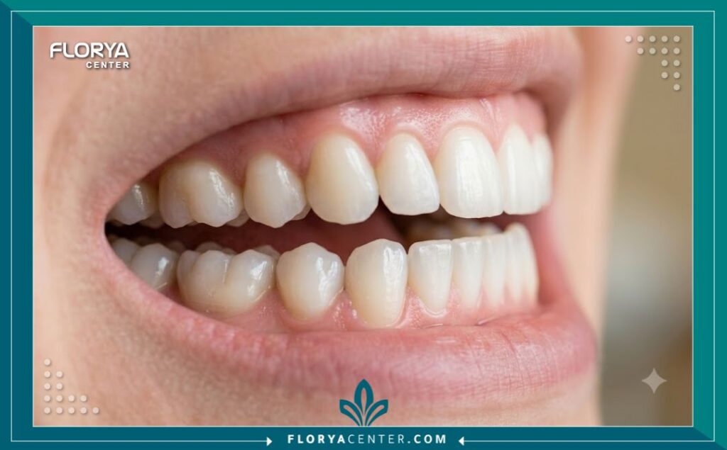 حشو دائم في تركيا 5 لقطة قريبة توضح صحة وجمال الأسنان بعد تطبيق الحشو الدائم لضمان حماية السن من البكتيريا.