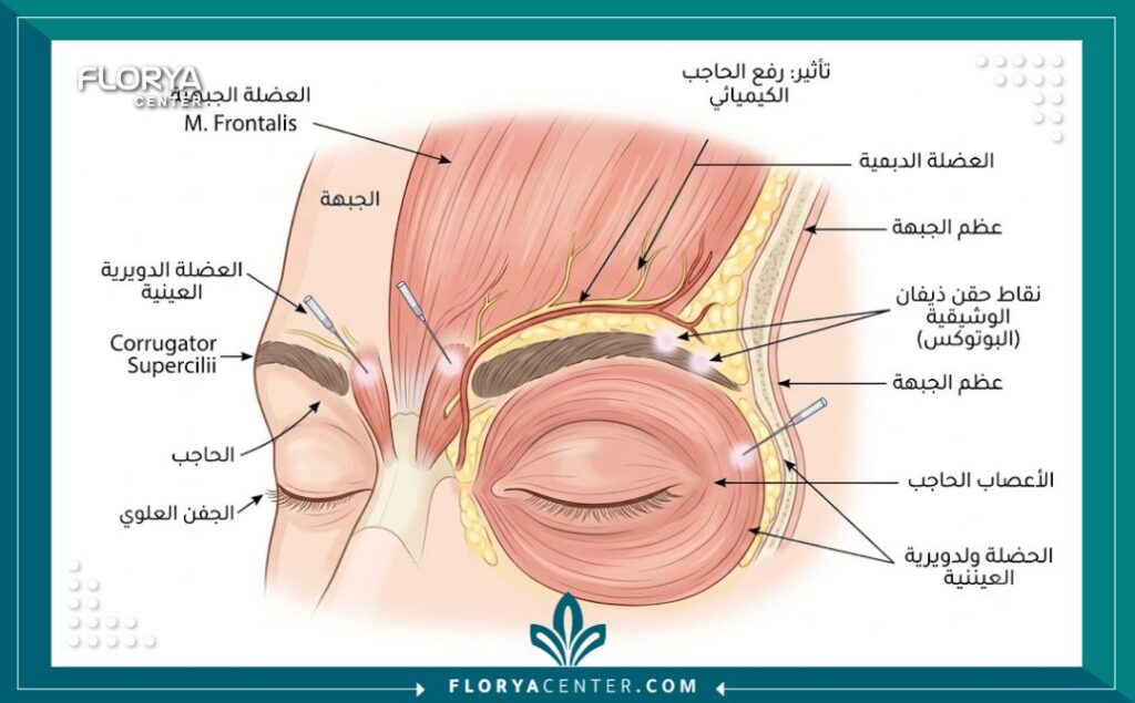 رسم توضيحي طبي لกายية عضلات الوجه ويوضح النقاط الدقيقة لحقن البوتوكس لرفع ذيل الحاجب والجفن المترهل.
