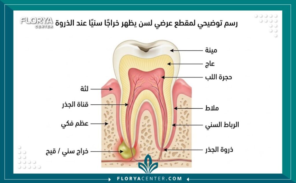 رسم تخطيطي طبي يوضح تشريح خراج جذر السن وتجمع الصديد في اللثة.