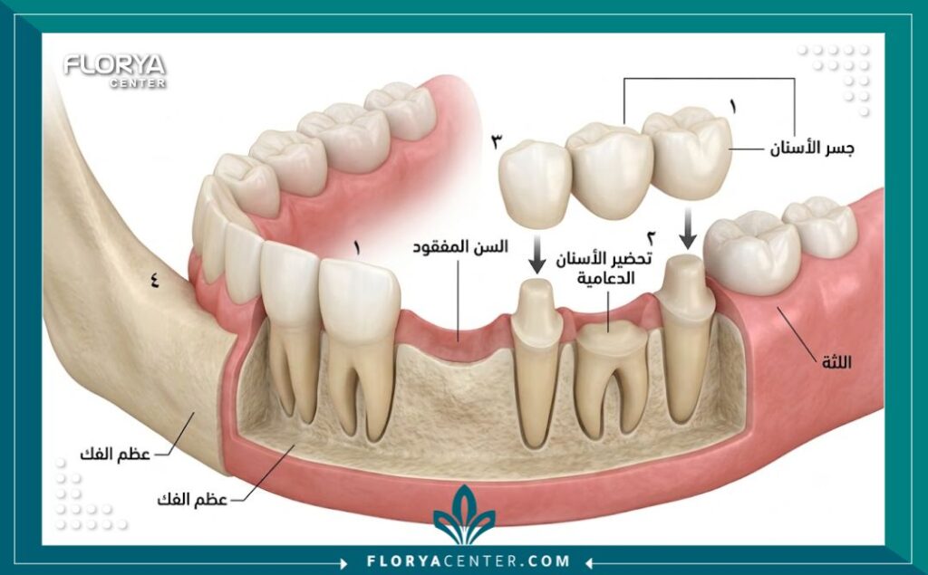 رسم توضيحي طبي دقيق يشرح أولى خطوات تركيب جسر الاسنان المتمثلة في برد وتجهيز الأسنان المجاورة لتعويض السن المفقود.