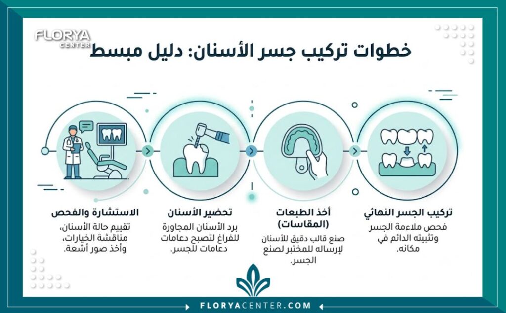 إنفوجرافيك تفصيلي يوضح بالترتيب خطوات تركيب جسر الأسنان بداية من الفحص وأخذ الطبعة السنية وحتى التركيب النهائي.
