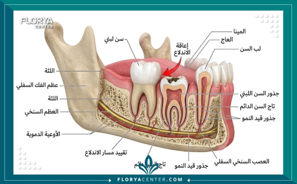 رسم توضيحي طبي لفك طفل يوضح كيف يعيق السن اللبني ظهور السن الدائم تحته.