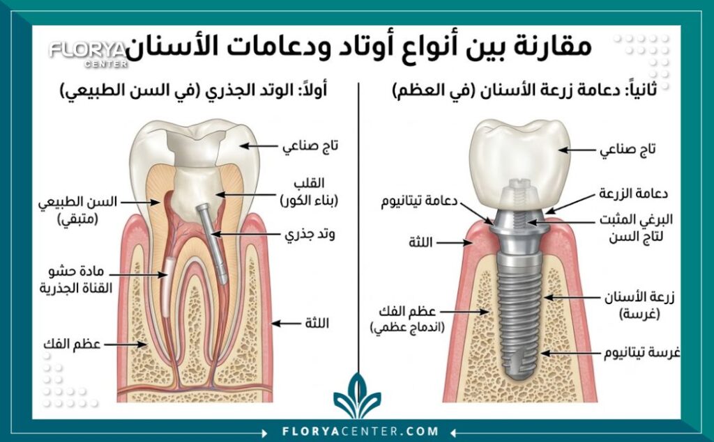 رسم توضيحي طبي يوضح الفرق بين وتد الأسنان بعد سحب العصب ودعامة زراعة الأسنان في الفك.