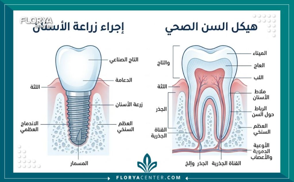 رسم توضيحي طبي لتركيب زراعة الأسنان في أفضل عيادات الأسنان في تركيا.