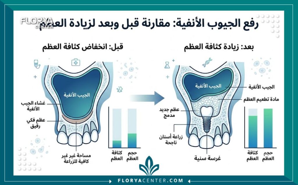 إنفوجرافيك يوضح مقارنة لسمك عظام الفك قبل وبعد عملية رفع جيوب الفك العلوي المفتوح والمغلق.