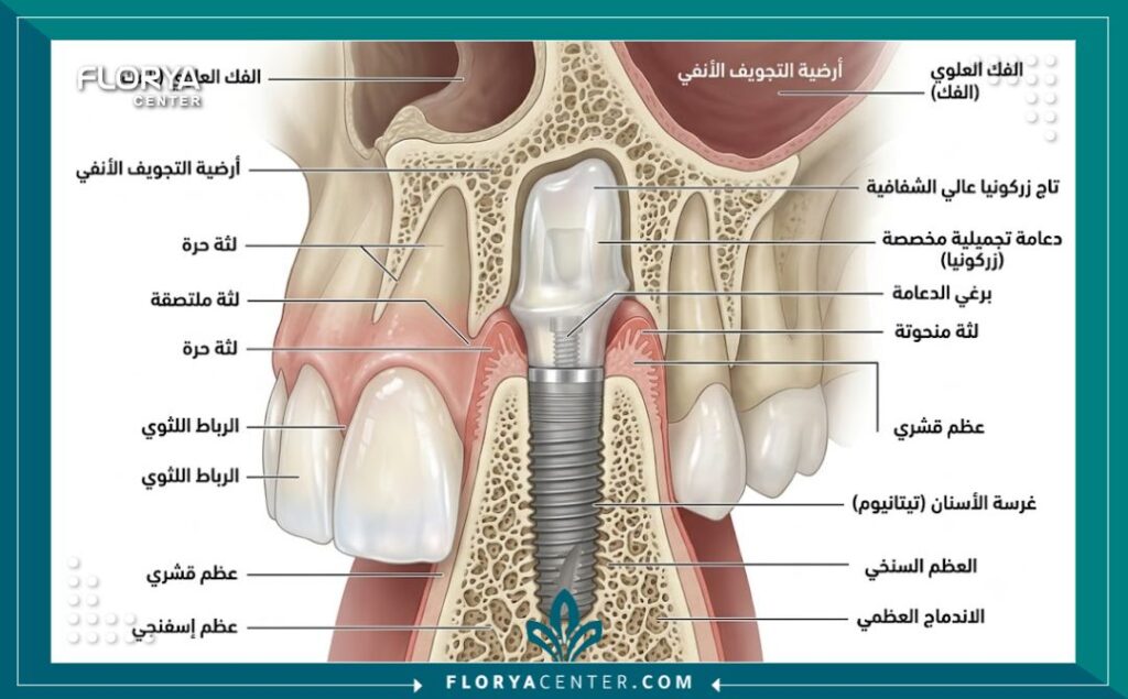 زراعة الاسنان الامامية في تركيا 2 رسم توضيحي طبي لتشريح زراعة الأسنان الأمامية يوضح المسمار التيتانيوم، الدعامة، والتاج التجميلي الشفاف.