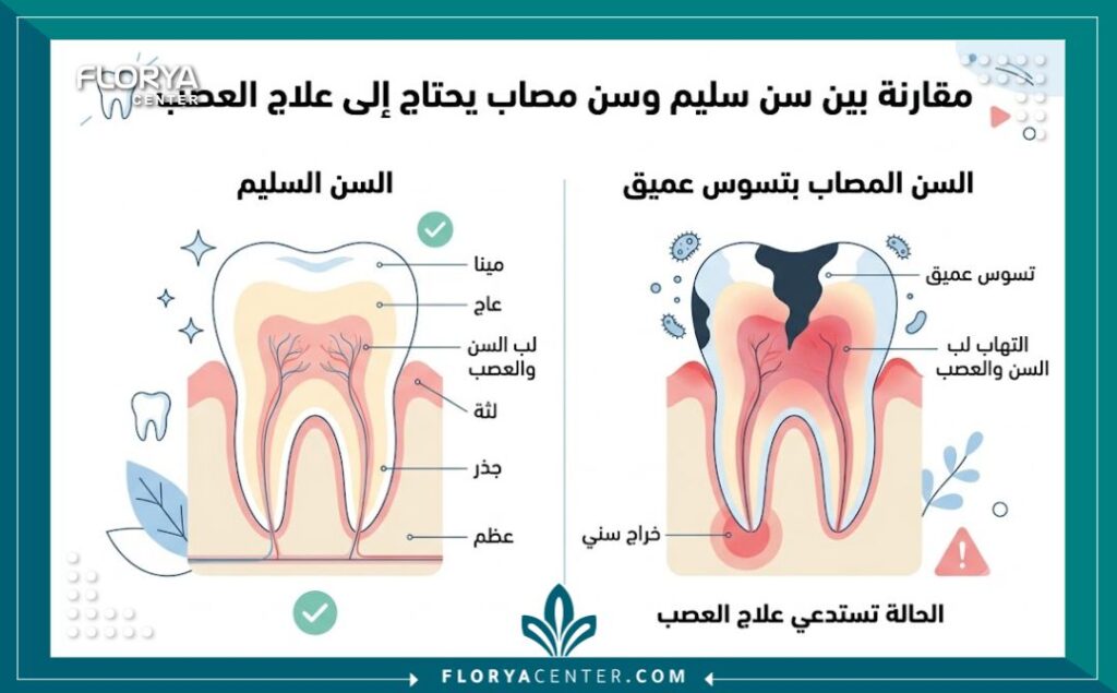 سحب العصب في تركيا 3 إنفوجرافيك مقارنة يوضح الفرق بين السن السليم والسن المصاب بالتهاب العصب الذي يحتاج إلى علاج جذري.