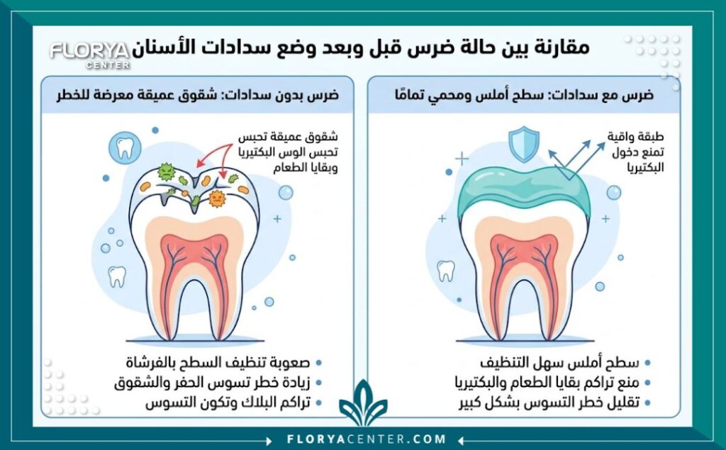 إنفوجرافيك يقارن بين الأضراس المعرضة للتسوس والأضراس المحمية باستخدام سدادات الشقوق السنية الوقائية.