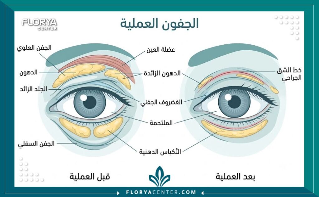 سعر شد الجفون في تركيا 2 مخطط توضيحي طبي يوضح تشريح العين والمناطق المستهدفة في عملية شد الجفون العلوي والسفلي.