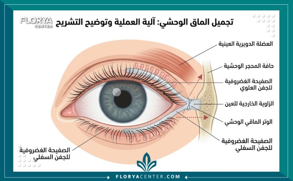 رسم توضيحي طبي لتشريح العين يوضح آلية إجراء عملية شد الجفون العرضي وتوسيع العين.