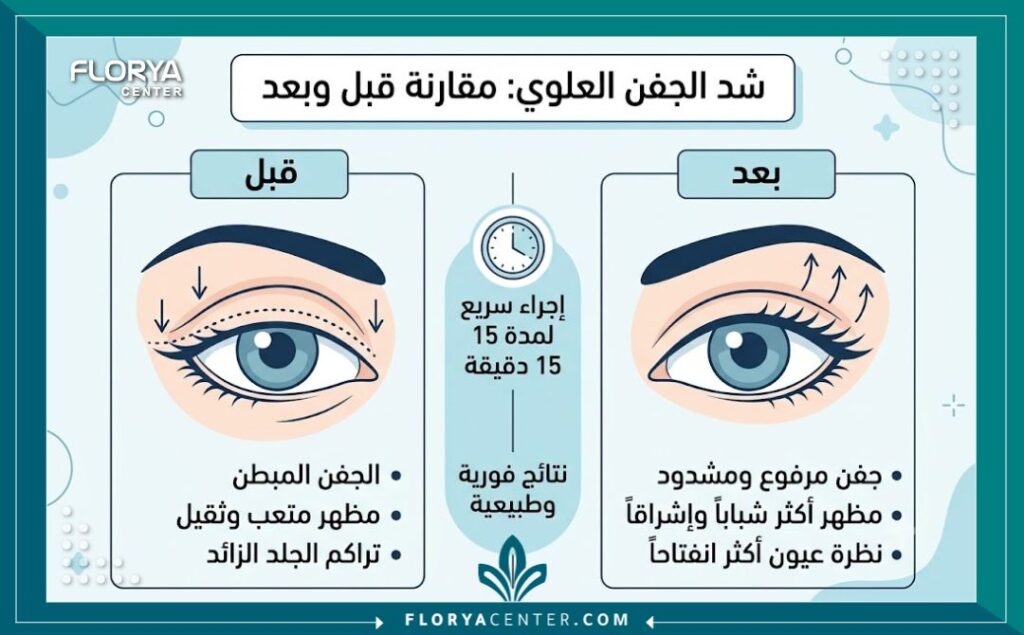 إنفوجرافيك يوضح مقارنة قبل وبعد إجراء شد الجفون العلوية بالخيوط الكورية وخطوات الإجراء السريع في 15 دقيقة.