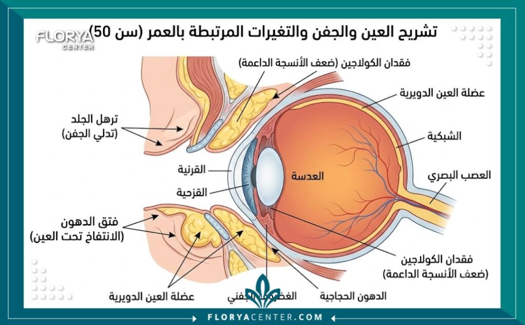 رسم توضيحي طبي يوضح تشريح العين وترهل الجفون ونقص الكولاجين الحاد في سن الخمسين الذي يتطلب تدخلاً جراحياً.
