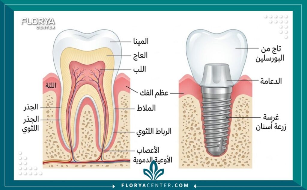 طبيب اسنان في تركيا 2 رسم توضيحي طبي يوضح تشريح السن وتركيب زراعة الأسنان في تركيا.