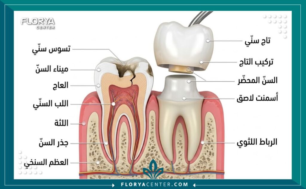 طربوش الاسنان في تركيا 2 رسم توضيحي طبي ثلاثي الأبعاد يوضح تشريح وكيفية تركيب طربوش الاسنان فوق السن التالف لحمايته.