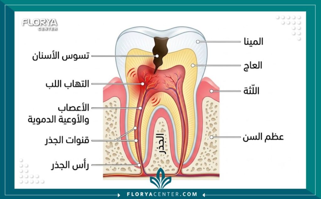 رسم توضيحي طبي لطبقات السن وعصب الأسنان يوضح أسباب وجع الأسنان الشديد.