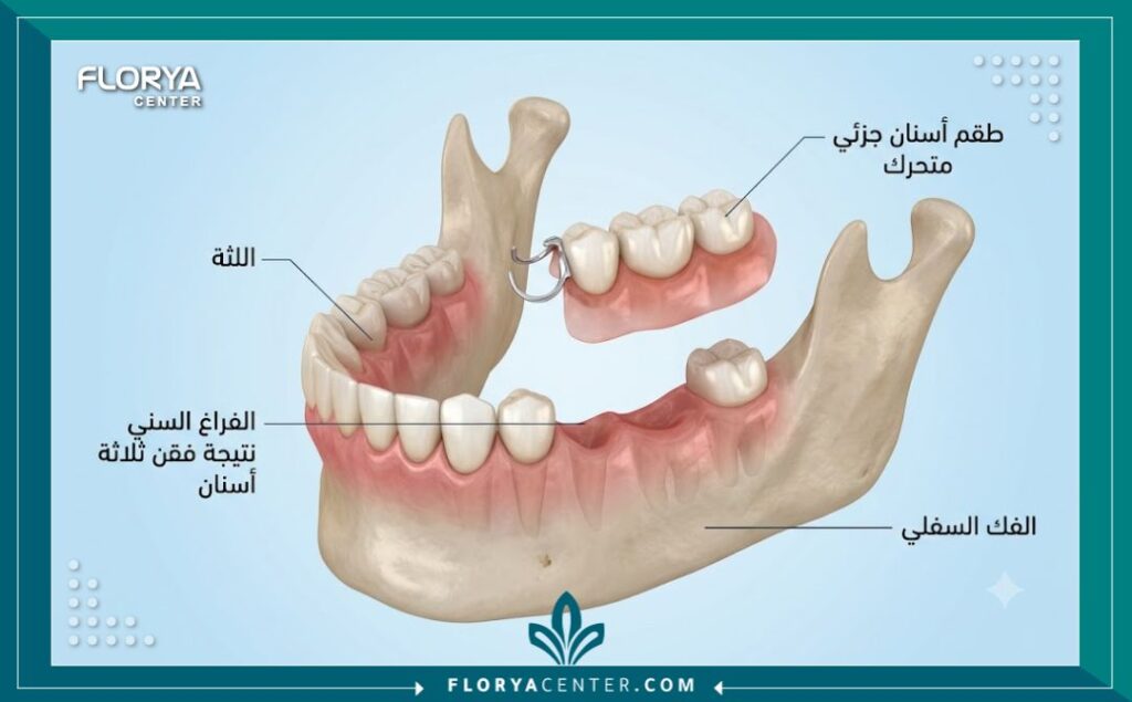 طقم اسنان جزئي في تركيا 2 رسم توضيحي طبي يوضح كيفية تركيب طقم اسنان جزئي في تركيا المتحرك في الفك لتعويض الأسنان المفقودة.
