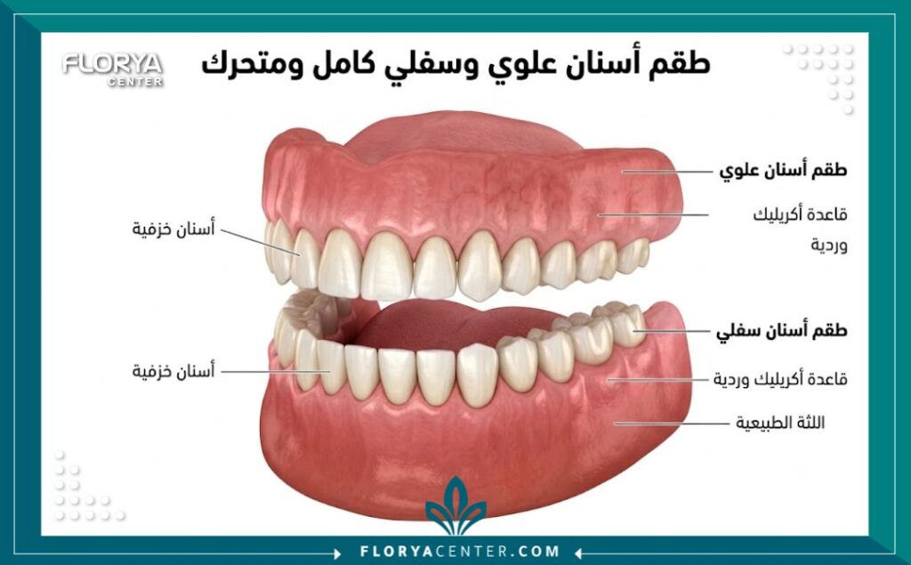 رسم توضيحي طبي يوضح تركيب طقم الأسنان الكامل والمتحرك على اللثة.