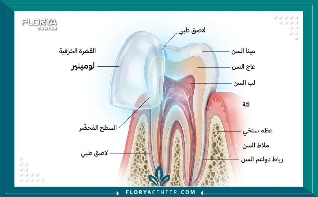 عدسات الاسنان في تركيا 2 رسم توضيحي طبي يوضح التركيب التشريحي لكيفية لصق عدسات الاسنان والقشور الخزفية الرقيقة على السن.