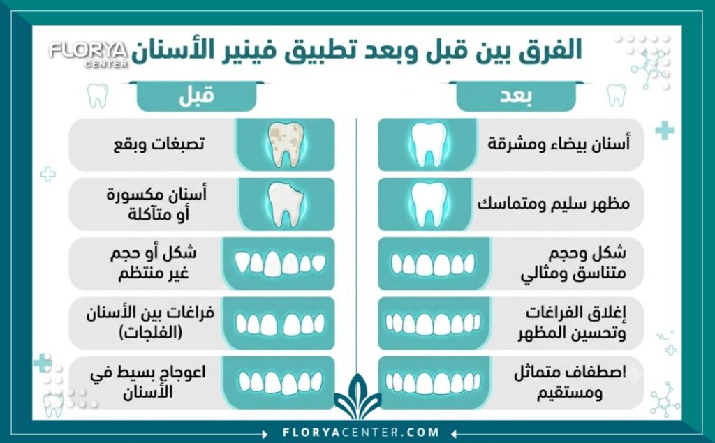 عدسات الاسنان في تركيا 3 إنفوجرافيك يقارن بين الأسنان الطبيعية والنتائج النهائية بعد تركيب عدسات الاسنان في تركيا.