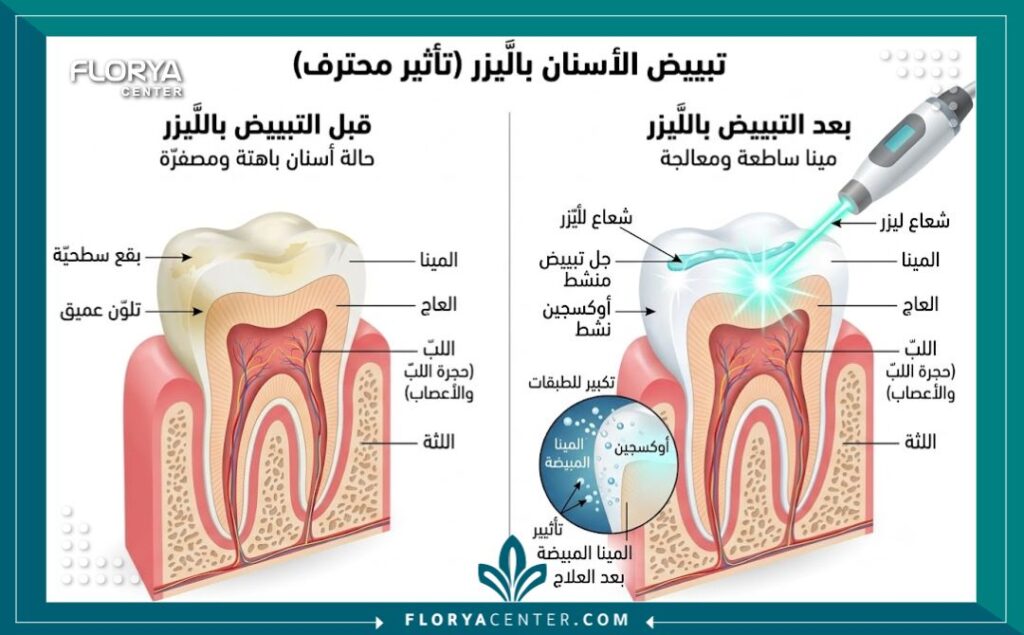 عروض تبييض الاسنان في تركيا 2 رسم توضيحي طبي لطبقات السن يوضح فعالية جلسات تبييض الأسنان بالليزر في تركيا.