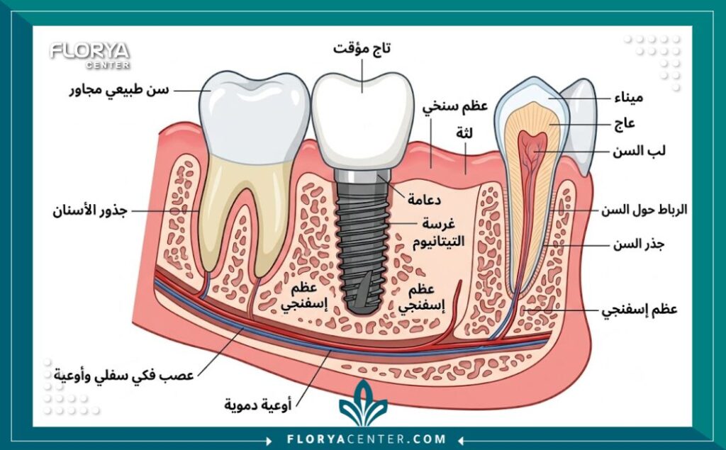 رسم توضيحي طبي يشرح تشريح وخطوات تركيب زراعة الاسنان الفورية في الفك خلال يوم واحد.
