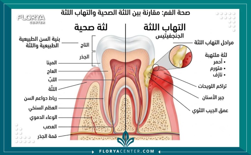 علاج التهاب اللثة في تركيا 2 رسم توضيحي طبي لتشريح الفم يقارن بين اللثة السليمة واللثة الملتهبة ويوضح أسباب التورم والنزيف.