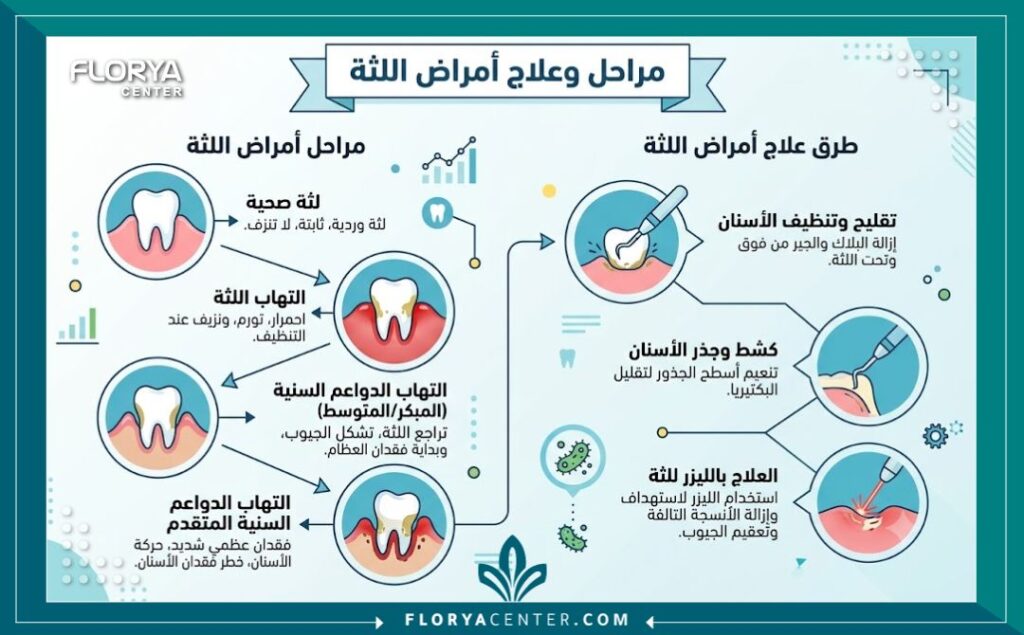 علاج التهاب اللثة في تركيا 3 إنفوجرافيك يوضح مراحل أمراض اللثة وخطوات علاج تراجع اللثة ونزيفها في العيادات.