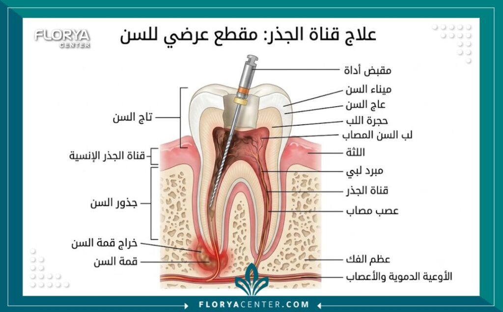 علاج العصب في تركيا 2 رسم توضيحي طبي دقيق لتركيب السن يوضح خطوات عملية تنظيف القنوات الجذرية وسحب العصب التالف لإنقاذ السن.