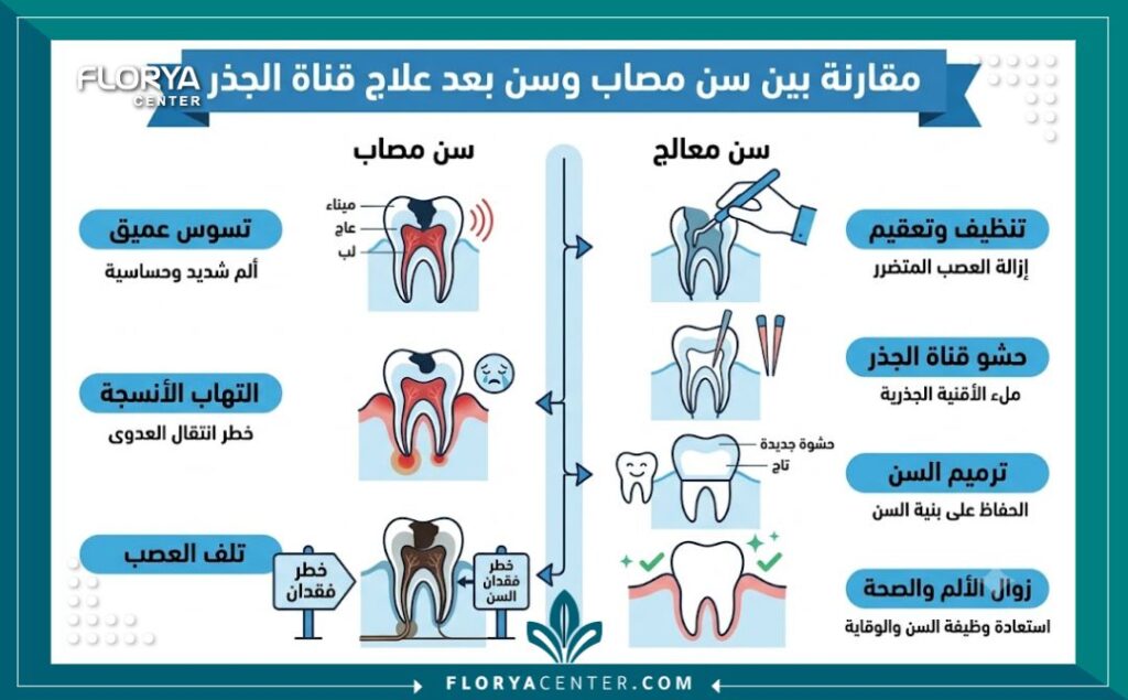 علاج العصب في تركيا 3 إنفوجرافيك طبي يقارن بين السن الملتهب والسن السليم ويوضح أهمية علاج العصب في تركيا لإنقاذ الأسنان من الخلع.