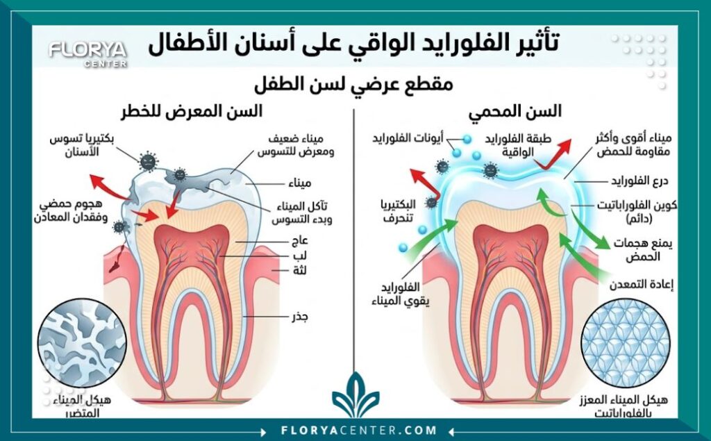 رسم توضيحي طبي يوضح كيف يقوم علاج الفلورايد بتقوية المينا وحماية الأسنان اللبنية والدائمة من التسوس.