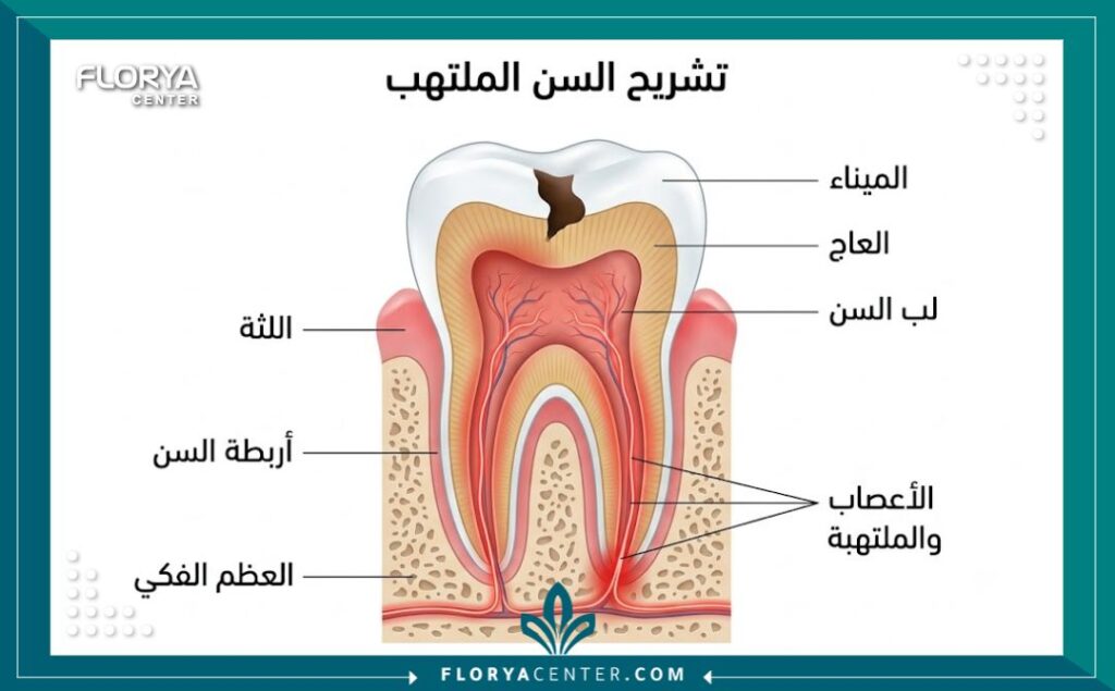 رسم توضيحي طبي لتشريح السن يوضح التهاب العصب المسبب للألم، أسباب ألم الأسنان الشديد.