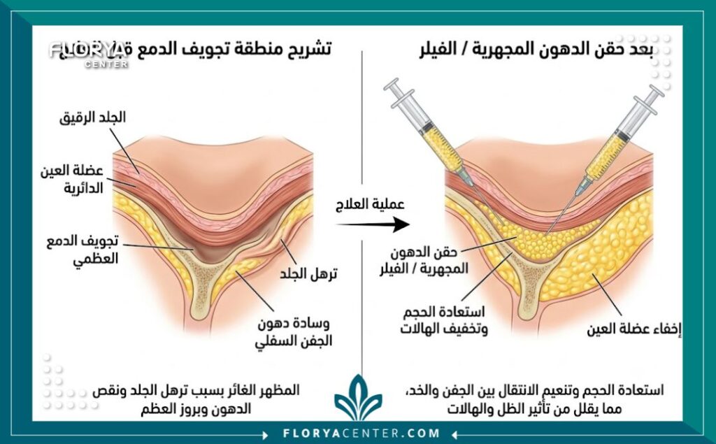 علاج الهالات السوداء الوراثية 2 رسم تخطيطي طبي يوضح تشريح منطقة تحت العين وتأثير حقن الدهون المجهرية في ملء تجويف الدمع وعلاج الهالات الوراثية.