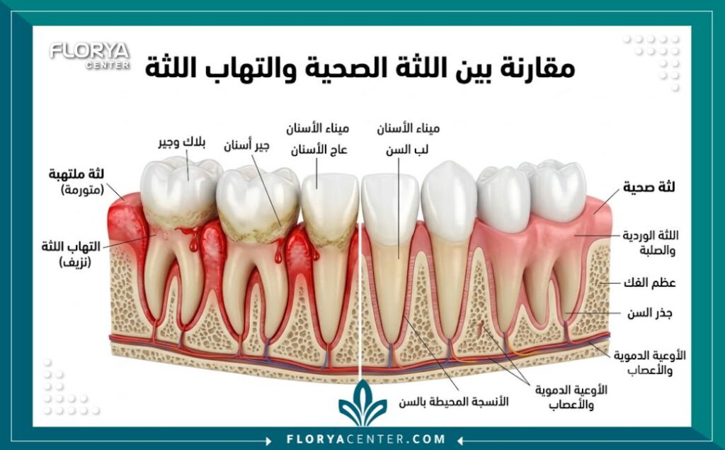 رسم توضيحي طبي لتشريح اللثة يوضح الفرق بين اللثة الملتهبة واللثة السليمة وكيفية علاج احتقان اللثة.