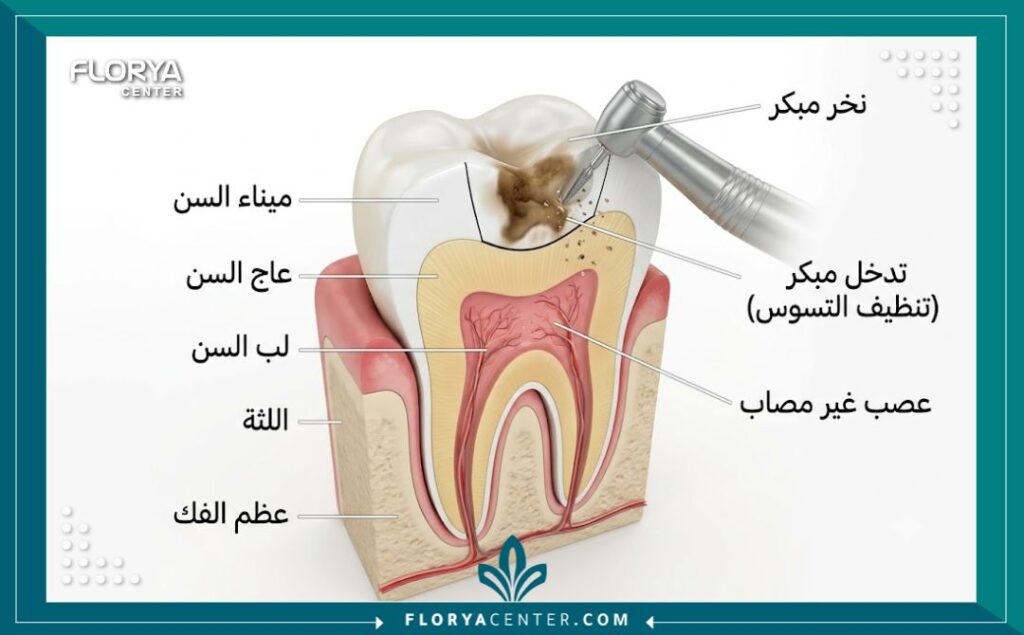 علاج تسوس الاسنان في تركيا 2 رسم توضيحي تشريحي لطبقات السن يوضح عملية تنظيف النخر ووضع حشوة الأسنان قبل وصول التسوس إلى العصب.